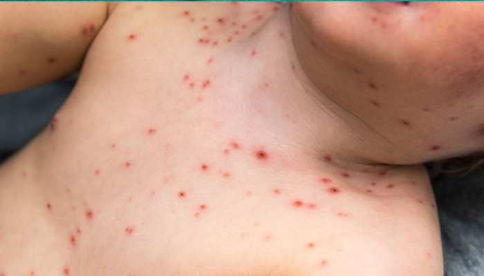 Chickenpox Infection